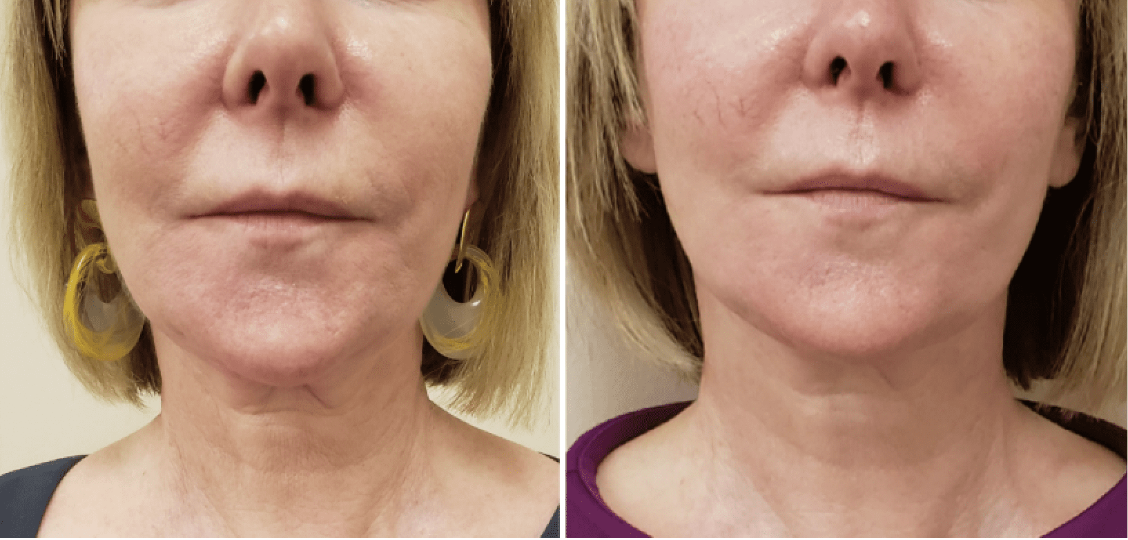 Freeze Infusion Facelift Neck Lift and Skin Tightening Immidiate Results