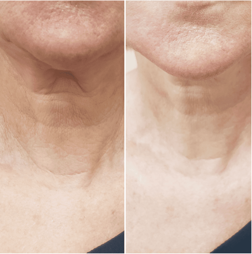 Freeze Infusion Facelift, Neck Lift and Skin Tightening