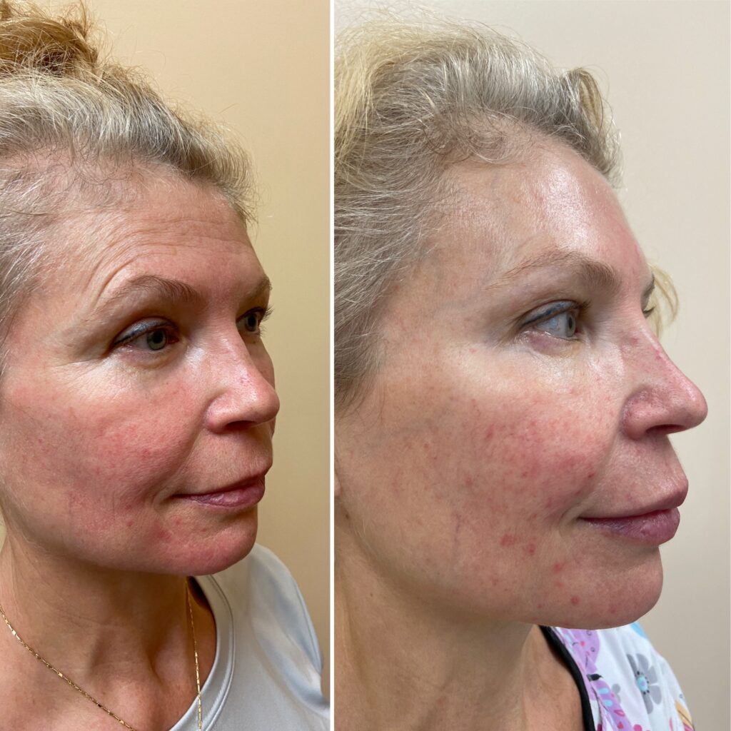 Botox Before and After XBody Health and Wellness