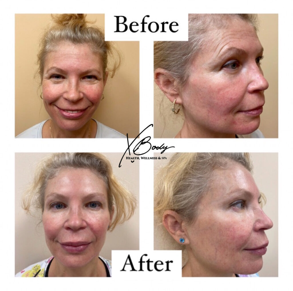 Fillers and Botox Before and After