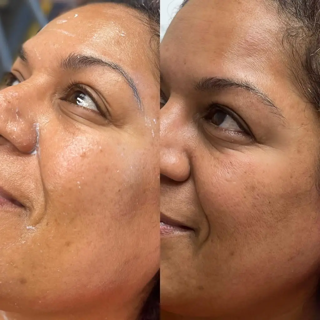 Instant result after one Sylfirm X RF microneedling treatment