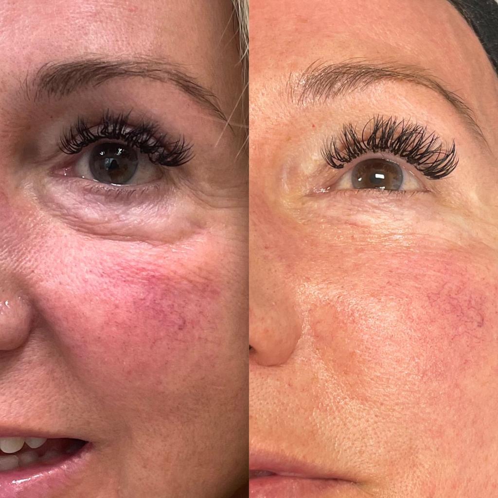 Our RF Microneedling Sylfirm X Treatment Results XBody Health, Wellness & Spa